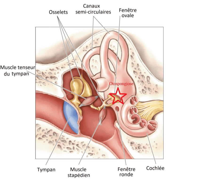 Otospongiose : quelle est  cette maladie des osselets ?