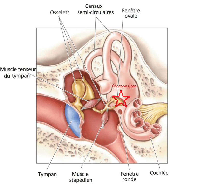L’Otospongiose : une maladie des osselets