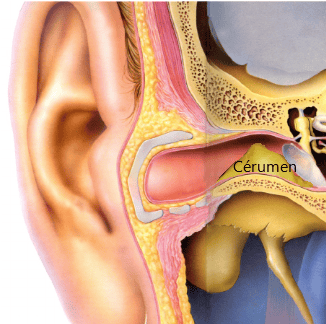 Coupe d'une oreille pour voir l'emplacement du cérumen dans le conduit auditif