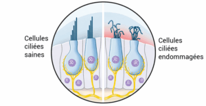 Atteinte des cellules de l'oreille interne par presbyacousie ou traumatisme sonore