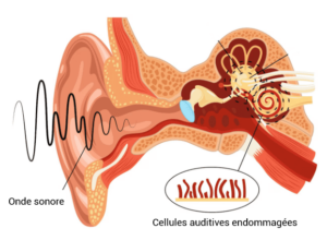 Cellules ciliées endommagées