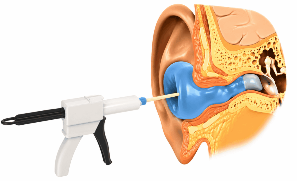 Réalisation d’une empreinte d’oreille pour des bouchons de natation sur mesure